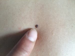 首イボの糸状疣贅の正体を探る 首イボマスター 首イボの糸状疣贅の正体を探る 首イボマスター