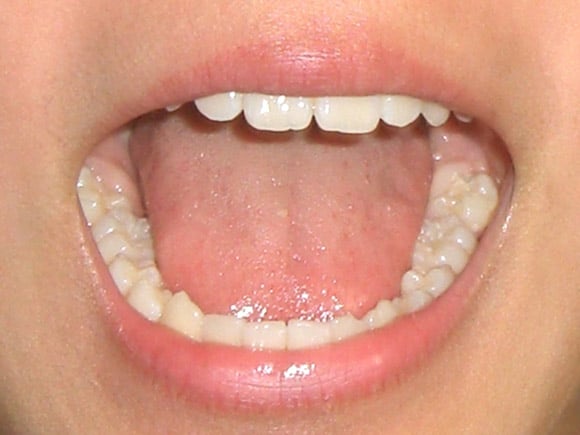 歯に発生している歯の黄ばみや黒ずみを解消できる魅力